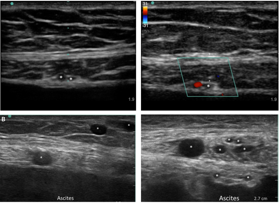 para linear probe vessel